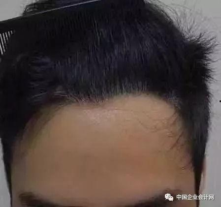 发际线后移图片,揭秘现代生活压力下的头发危机